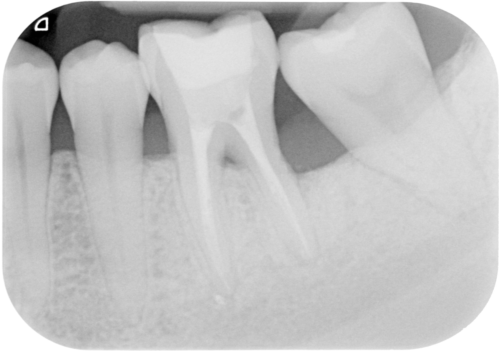 Case 3 - 1 year after surgery