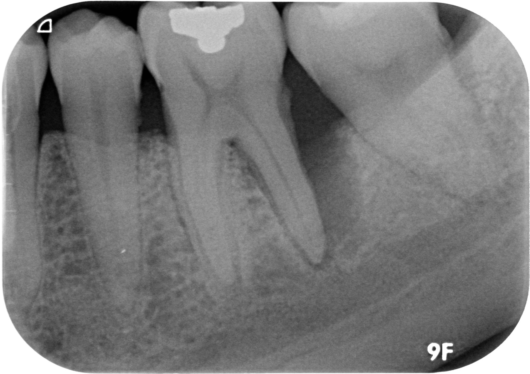 Case 3 - Pre treatment bone regeneration surgery