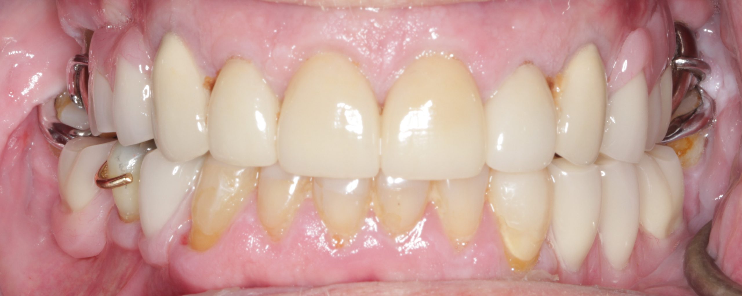 Case 4 retracted smile post op