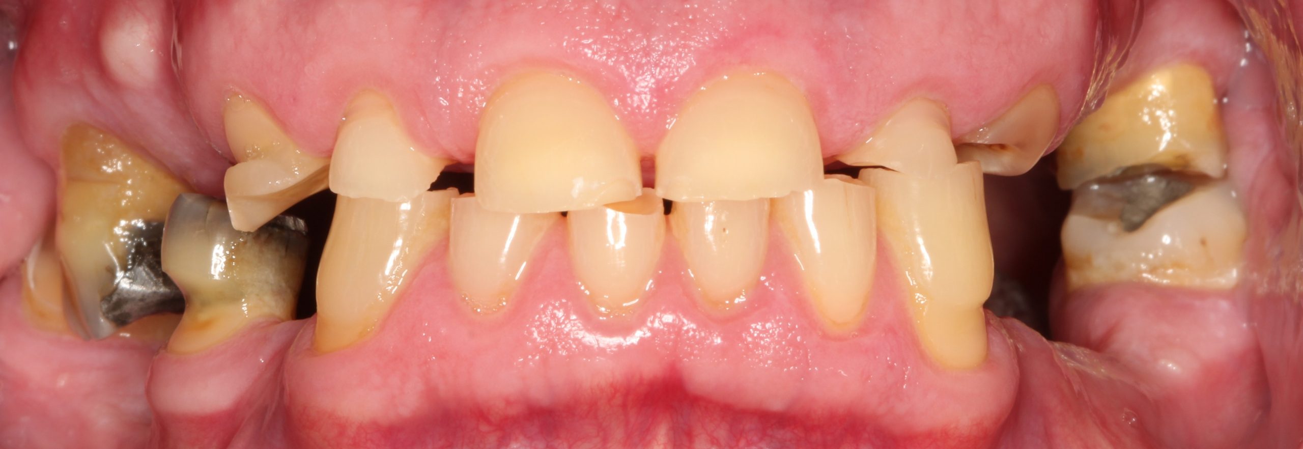 Case 4 retracted smile pre op